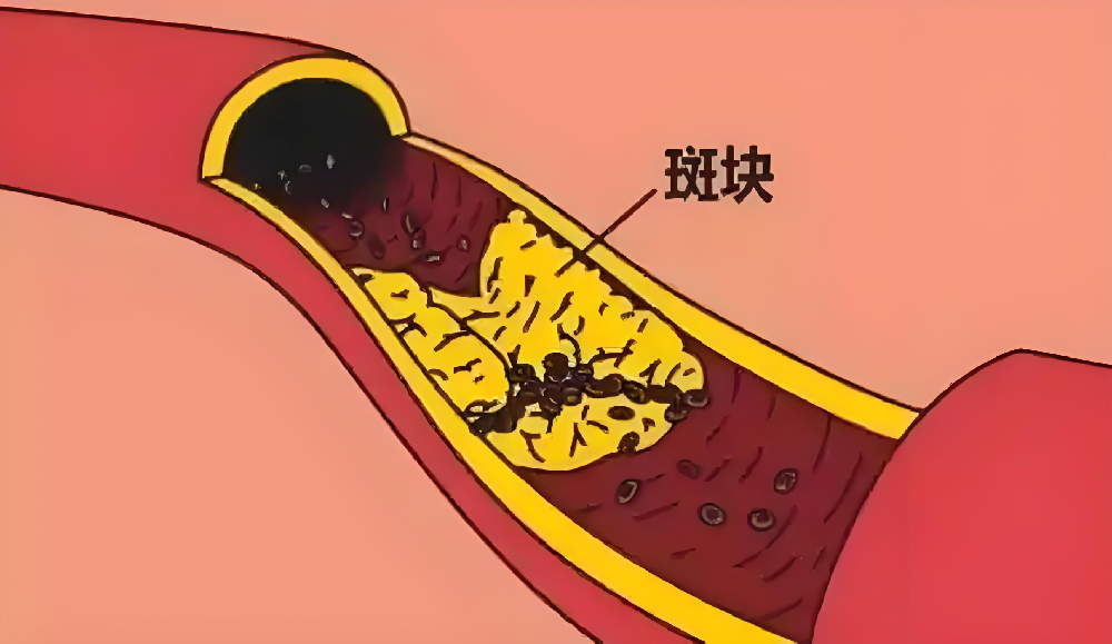 颈动脉斑块怎么回事？