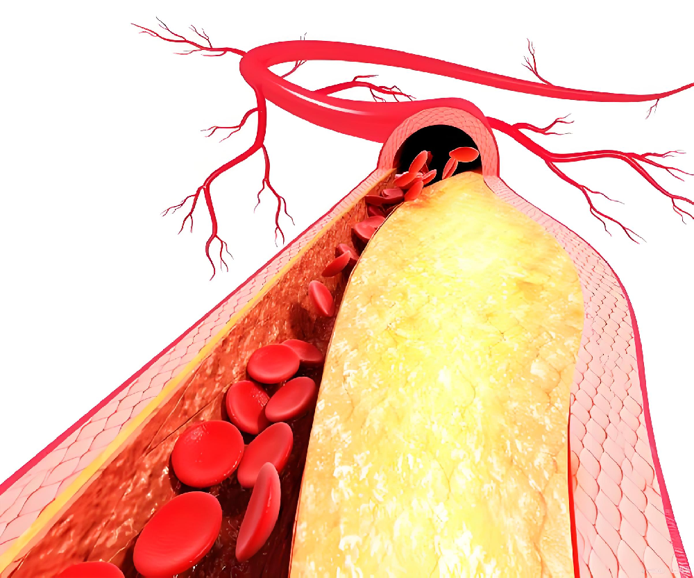 出现颈动脉斑块怎么办？