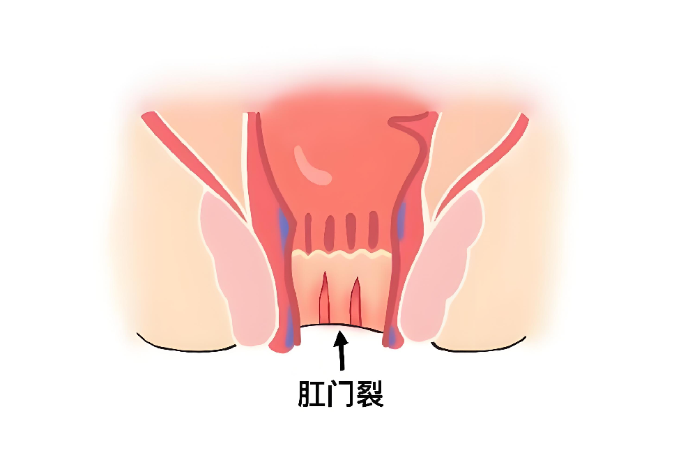 肛裂之痛：解锁隐藏在“难以启齿”背后的秘密