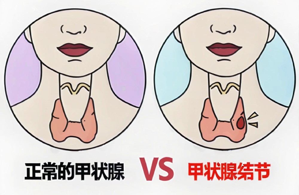 甲状腺结节高发！这三大诱因要知道