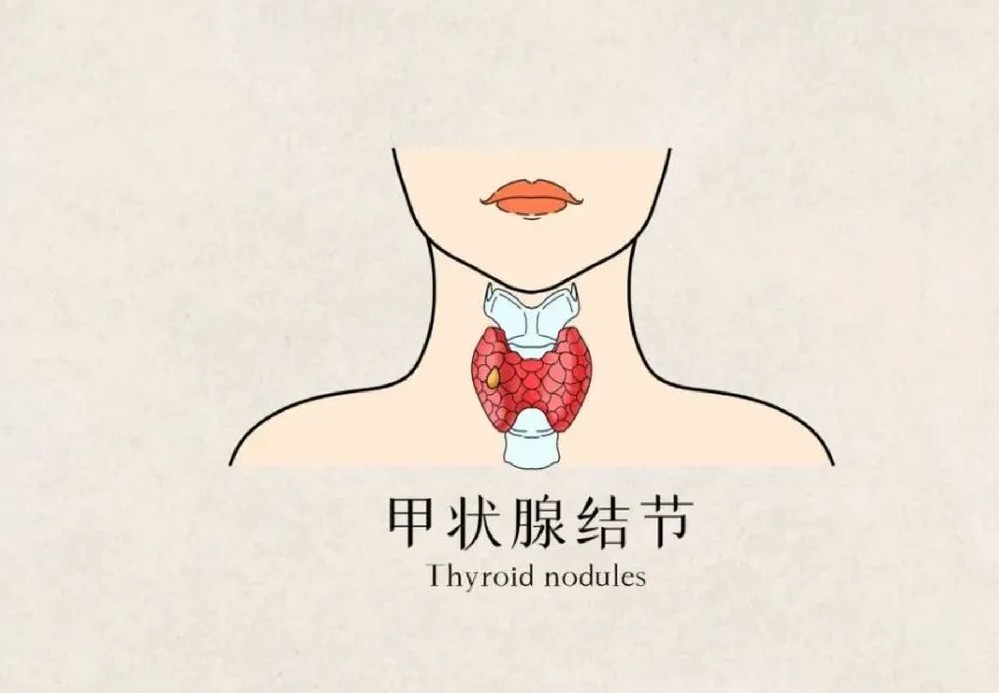 中医告诉你，甲状腺结节与甲亢有何异同？