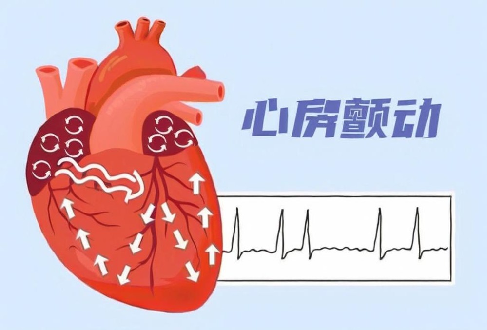 心脏砰砰乱跳？张育新主任提醒：这可能是房颤，危害不容小觑！