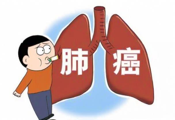 不要错过身体里的“求救信号”，这可能是肺癌早期预警