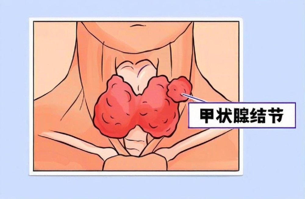 甲状腺结节悄悄长，原因出在代谢上