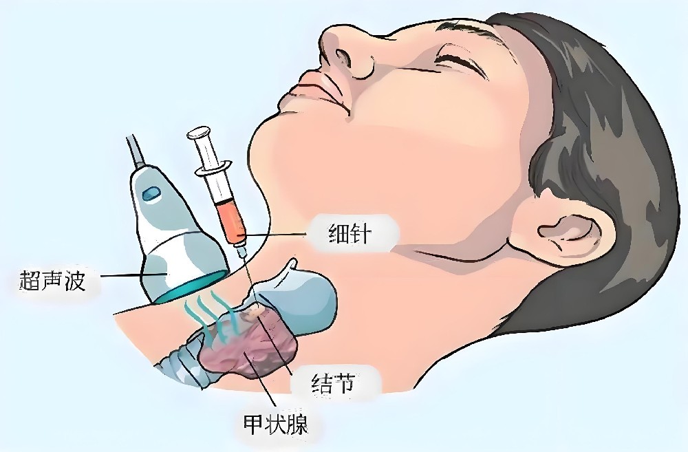 甲状腺结节调理：南京太乙堂教你，按结节变化选中医时机